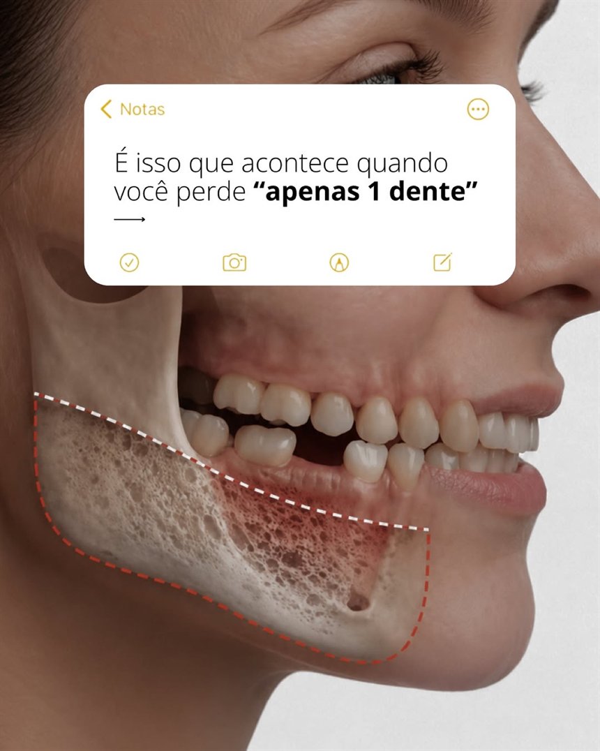 Post do Instagram mostrando o que acontece na boca após a perda de um dente